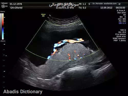 سونوگرافی انومالی